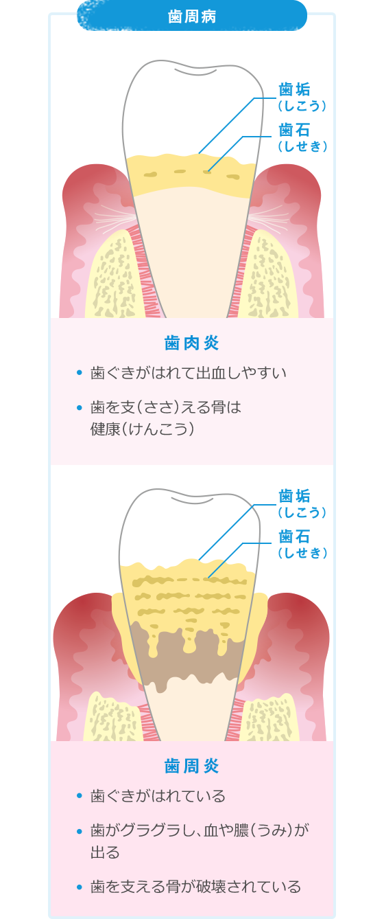 歯周病 歯肉炎 ・歯ぐきがはれて出血しやすい ・歯を支（ささ）える骨は健康（けんこう） ・歯ぐきがはれている ・歯がグラグラし、血や膿（うみ）が出る ・歯を支える骨が破壊されている
