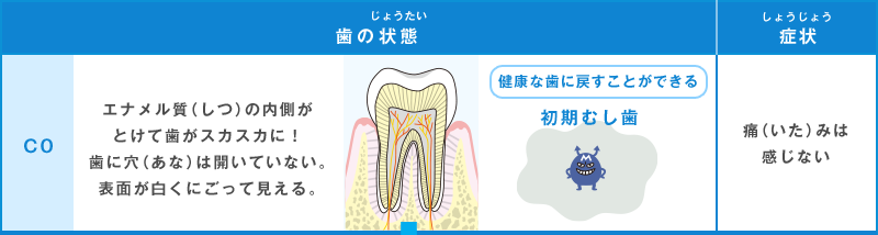 健康な歯に戻すことができる C0 初期むし歯 エナメル質（しつ）の内側がとけて歯がスカスカに！歯に穴（あな）は開いていない。表面が白くにごって見える。 痛（いた）みは感じない