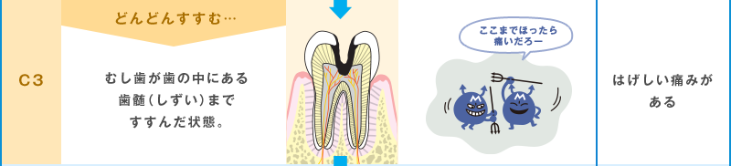 治療（ちりょう）が必要 C3 どんどんすすむ… むし歯が歯の中にある歯ずいまですすんだ状態。 ここまでほったら痛いだろー はげしい痛みがある