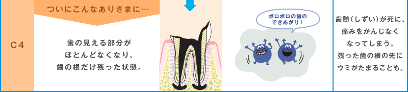 治療（ちりょう）が必要 C4 ついにこんなありさまに… 歯の見える部分がほとんどなくなり、歯の根だけ残った状態。 ボロボロの歯のできあがり！ 歯ずいが死に、痛みをかんじなくなってしまう。残った歯の根の先にウミがたまることも。
