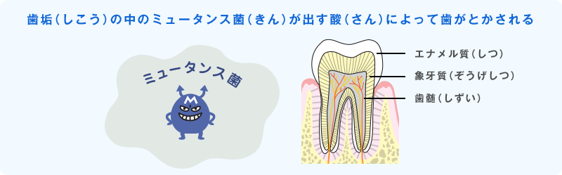 歯垢（しこう）の中のミュータンス菌（きん）が出す酸（さん）によって歯がとかされる