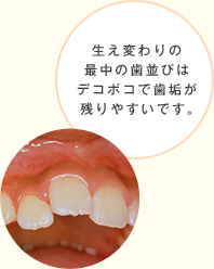 生え変わりの最中の歯並びはデコボコで歯垢が残りやすいです。