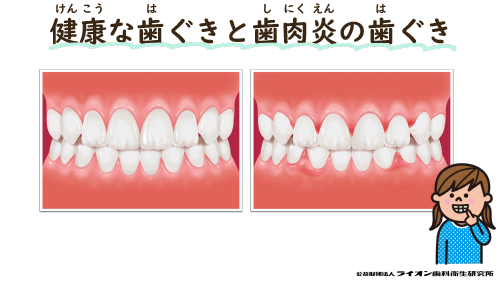 健康な歯ぐきと歯肉炎（しにくえん）の歯ぐき