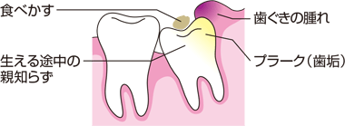 抜歯や治療が他の歯に比べて困難