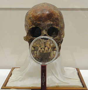 叉状研歯を持つ縄文時代後期の頭蓋骨（愛知県歯科医師会所蔵）