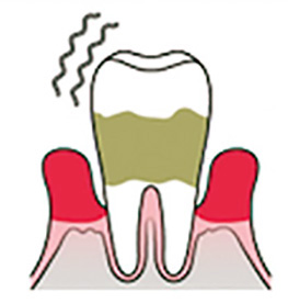 歯周病が進んだ歯ぐきでは、歯周病菌が増殖しやすい