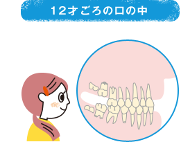 12才ごろの口の中