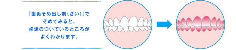 「歯垢そめ出し剤（ざい）」でそめてみると、歯垢のついているところがよくわかります。