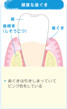 健康な歯ぐき ・歯ぐきは引きしまっていてピンク色をしている