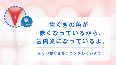 歯ぐきの色が赤くなっているから、歯肉炎になっているよ。 自分の歯ぐきもチェックしてみよう！