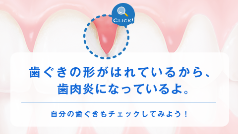 歯ぐきの形がはれているから、歯肉炎になっているよ。 自分の歯ぐきもチェックしてみよう！