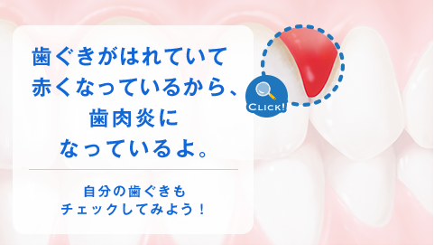 歯ぐきがはれていて赤くなっているから、歯肉炎になっているよ。 自分の歯ぐきもチェックしてみよう！