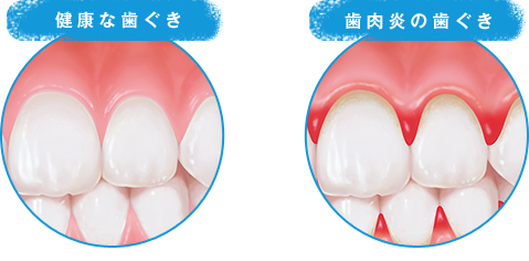 健康な歯ぐき 歯肉炎の歯ぐき