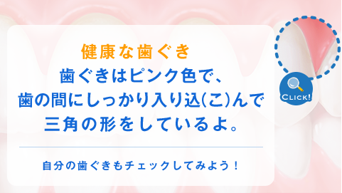 健康な歯ぐき歯ぐきはピンク色で、歯の間にしっかり入り込（こ）んで三角の形をしているよ。 自分の歯ぐきもチェックしてみよう！