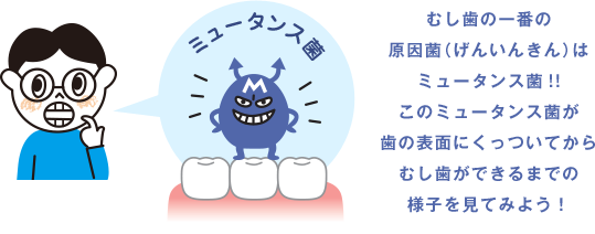 むし歯の一番の原因菌（げんいんきん）はミュータンス菌!!このミュータンス菌が歯の表面にくっついてからむし歯ができるまでの様子を見てみよう！