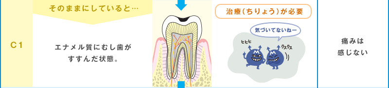 治療（ちりょう）が必要 C1 そのままにしていると… エナメル質にむし歯がすすんだ状態。 気づいてないねー 痛みは感じない