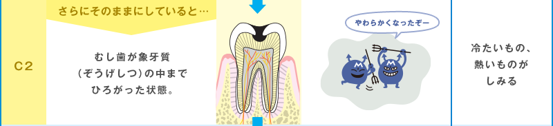 治療（ちりょう）が必要 C2 さらにそのままにしていると… むし歯が象牙質（ぞうげしつ）の中までひろがった状態。 やわらかくなったぞー 冷たいもの、熱いものがしみる