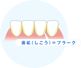 歯垢（しこう）＝プラーク