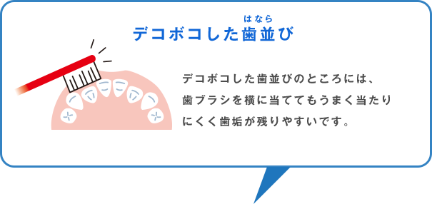 デコボコした歯並び デコボコした歯並びのところには、歯ブラシを横に当ててもうまく当たりにくく歯垢が残りやすいです。