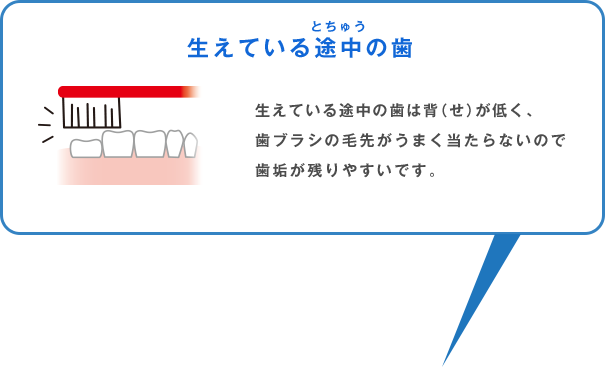 生えている途中の歯 生えている途中の歯は背（せ）が低く、歯ブラシの毛先がうまく当たらないので歯垢が残りやすいです。