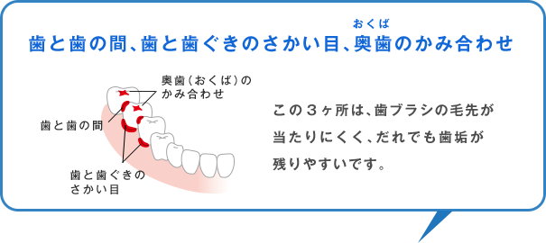 歯と歯の間、歯と歯ぐきのさかい目、奥歯のかみ合わせ この3ヶ所は、歯ブラシの毛先が当たりにくく、だれでも歯垢が残りやすいです。