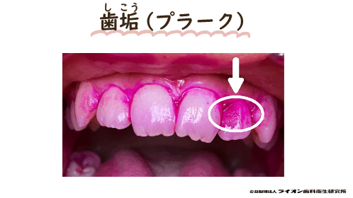 歯垢（プラーク）