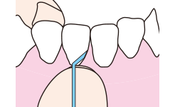 コンタクトポイントを通過したら、歯肉の少し中まで（スッと入るところまで）デンタルフロスを挿入します。
