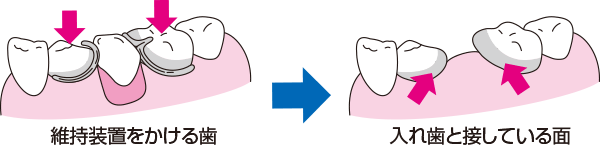 維持装置をかける歯→入れ歯と接している歯