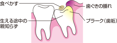 親知らずのケア方法 歯と口の健康研究室 ライオン歯科衛生研究所