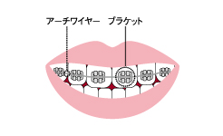 代表的な矯正装置の種類とケアのポイント