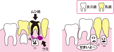 乳歯のむし歯もきちんと治療しましょう