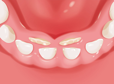 乳歯が抜ける前に、内側から永久歯が生え出している状態