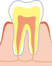 CO（Questionable Caries for Observation　シー・オー：初期むし歯）