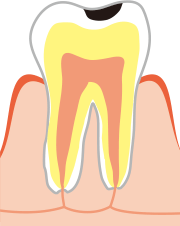 C1（エナメル質のむし歯）
