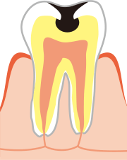 C2（象牙質まで進んだむし歯）