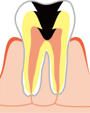 C3（歯髄まで進んだむし歯）
