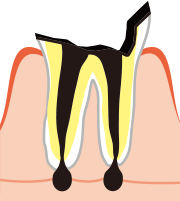 C4（歯根だけ残ったむし歯）