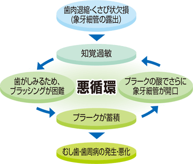 知覚過敏の進行