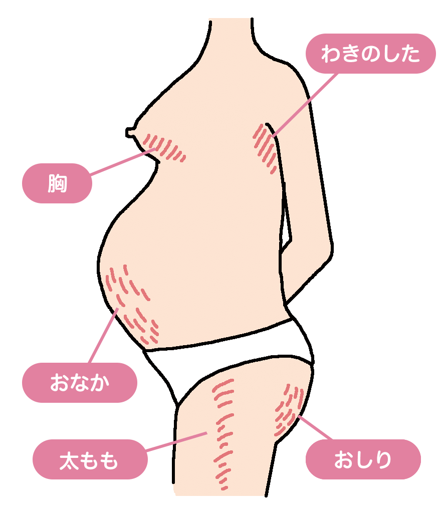 急激に体重が増えてしまうとできる 妊娠線 とは ママ あのね