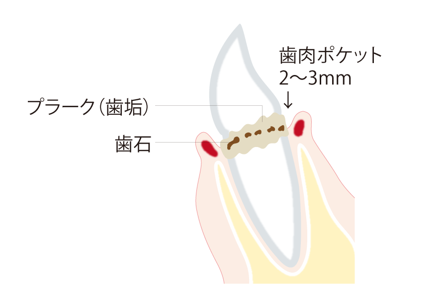 歯肉炎の症状