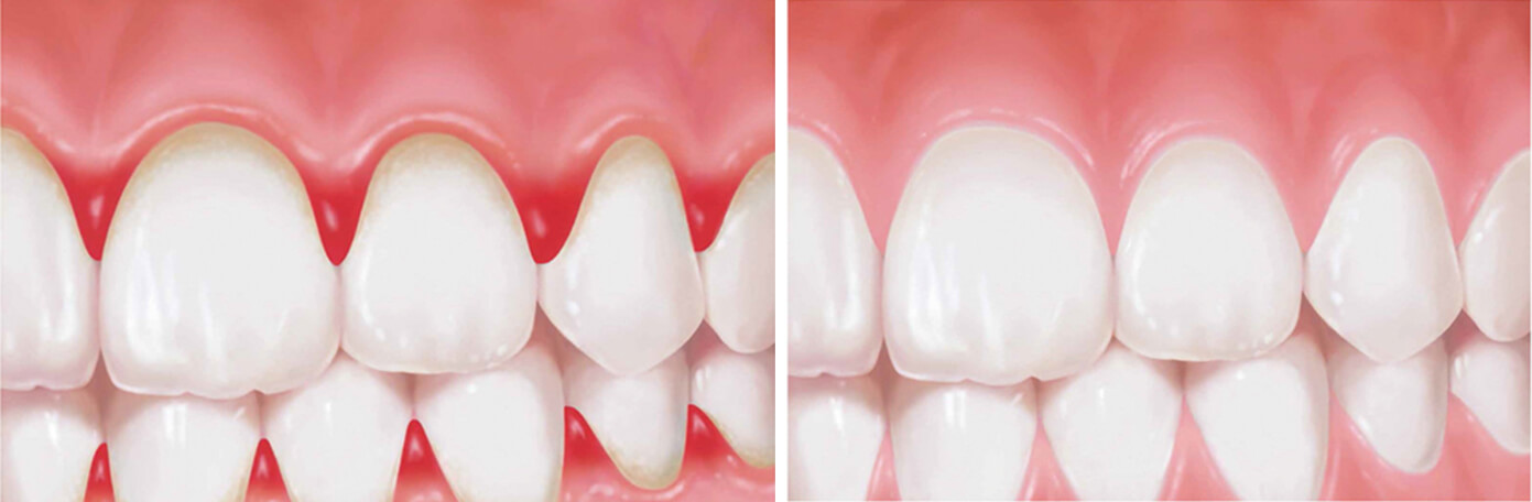 歯肉炎の歯ぐき（左）と健康な歯ぐき（右）