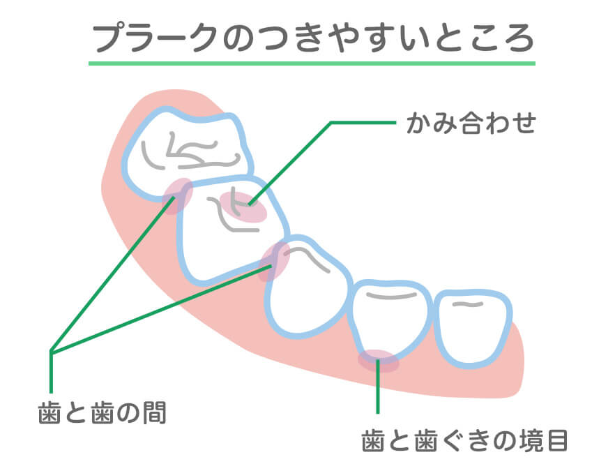 プラークのつきやすいところ