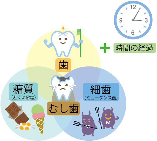 糖質（とくに砂糖）と細菌（ミュータント菌）、歯の質三つの要素と時間の経過でむし歯発生につながる