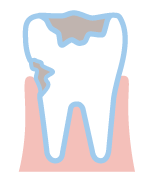 むし歯が発生