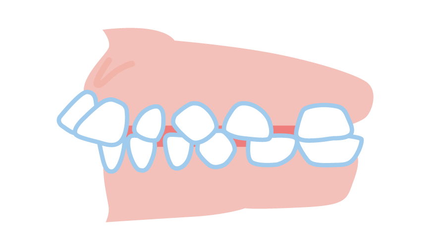 上顎前突（じょうがくぜんとつ）／出っ歯
