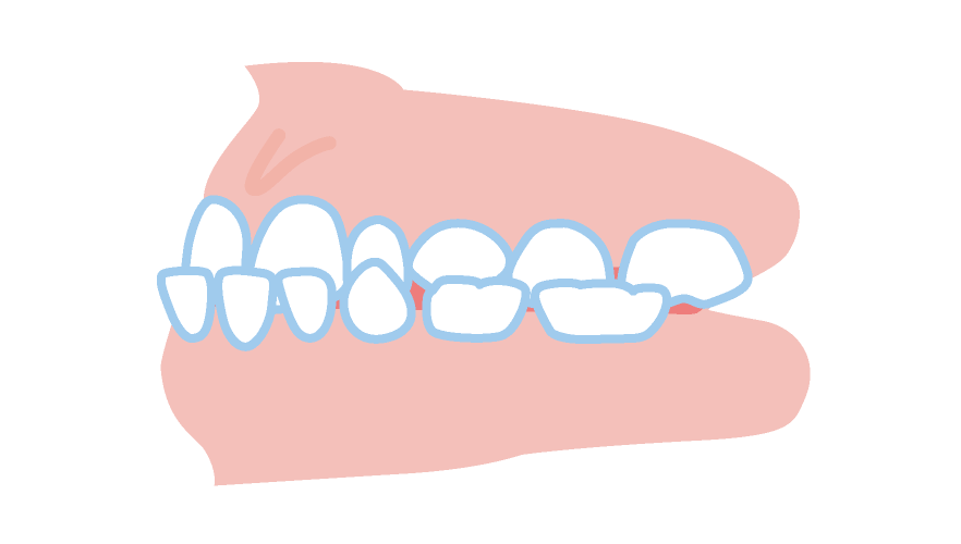 下顎前突（かがくぜんとつ）／反対咬合・受け口
