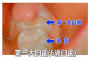 第一大臼歯の説明