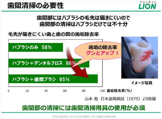 歯間清掃の必要性